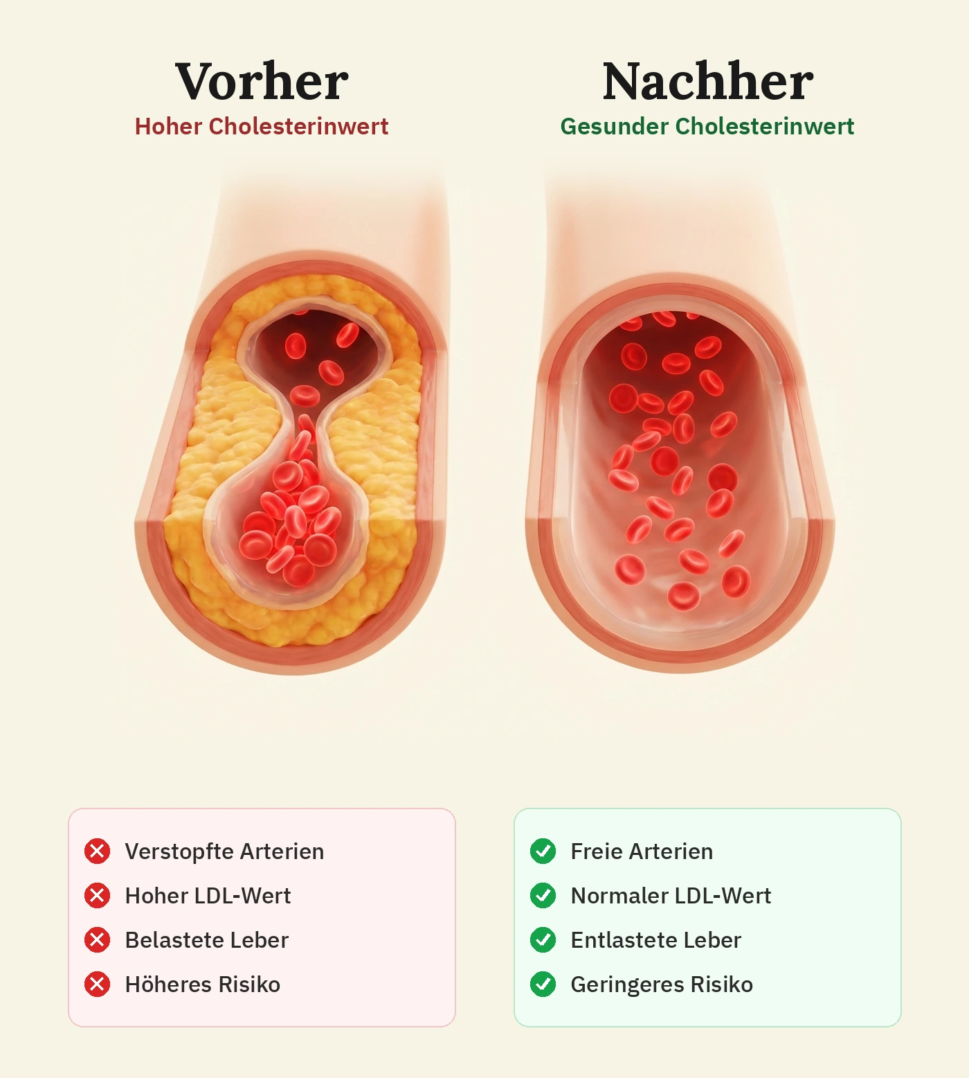Vorher-Nachher-Vergleich: verstopfte Arterie bei hohem Cholesterinwert gegenüber freiem Blutfluss bei gesundem Cholesterinwert
