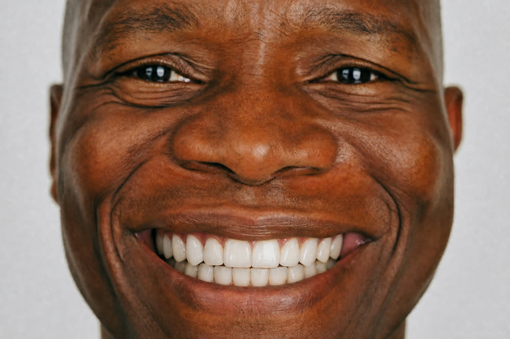 Second example smile after AI simulation