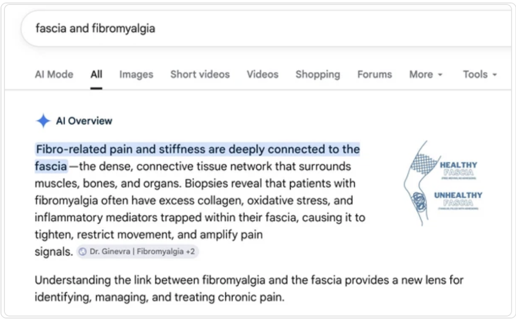 Google AI Overview search result for fascia and fibromyalgia