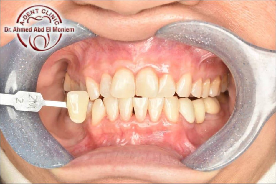 After: teeth at a much lighter shade (shade guide 2M2)