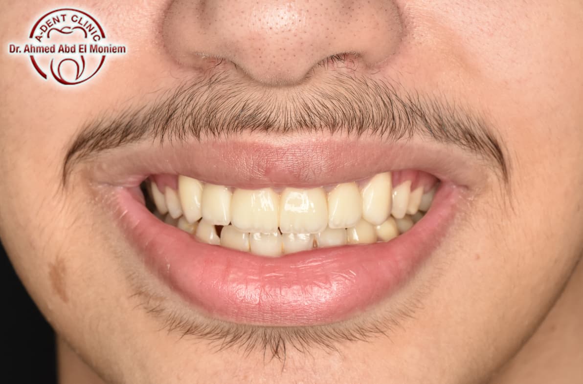 Before: case 1