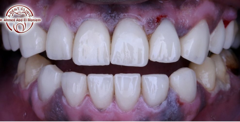 After: full mouth rehabilitation with new restorations
