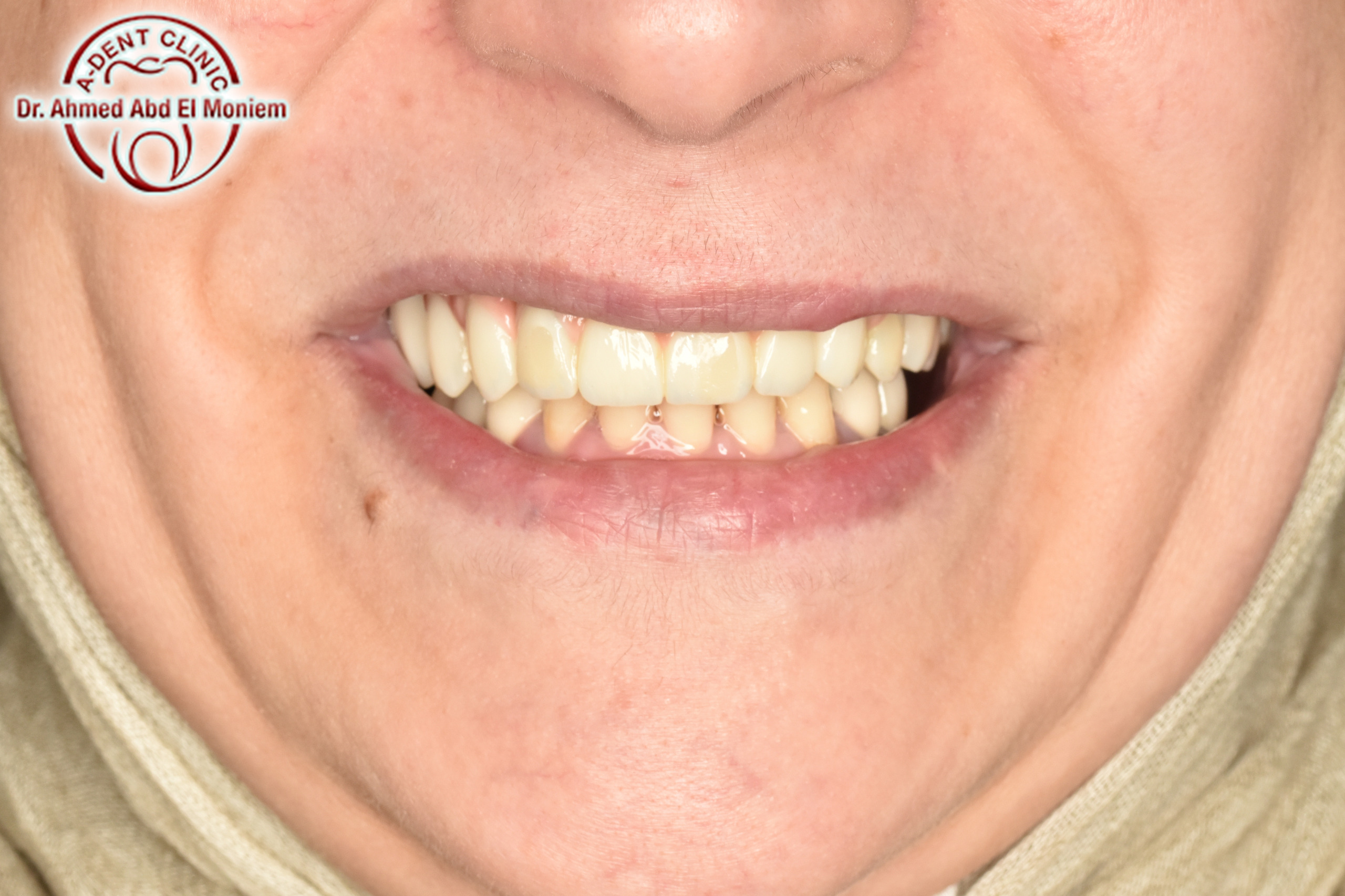 Before: case 14