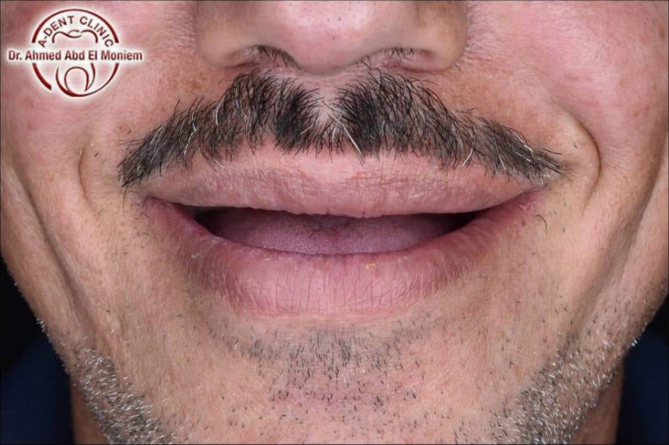 Before: completely missing upper teeth