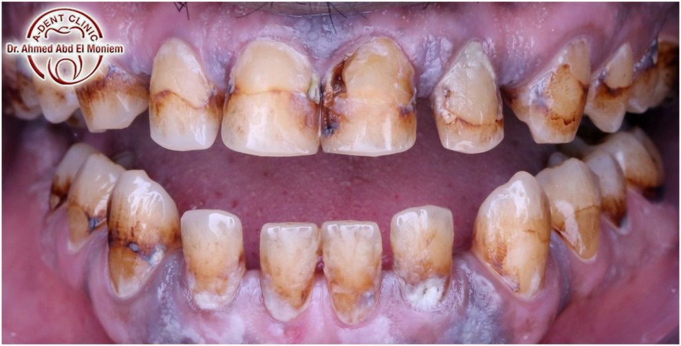 Before: severe decay and worn teeth