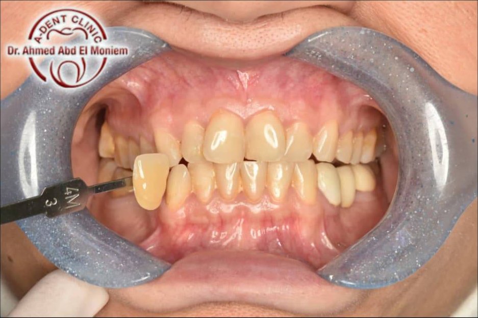 Before: teeth at a darker shade (shade guide 4M3)