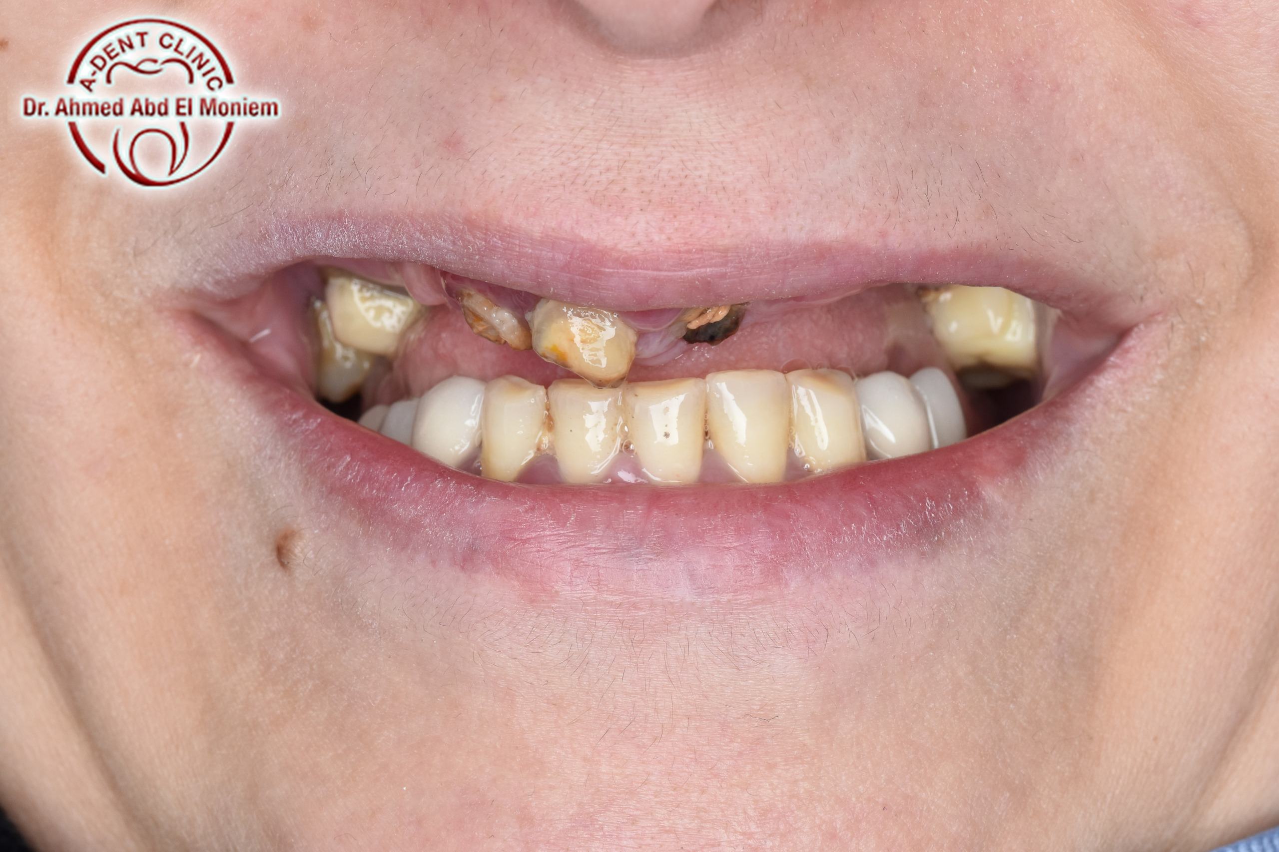 After: case 14
