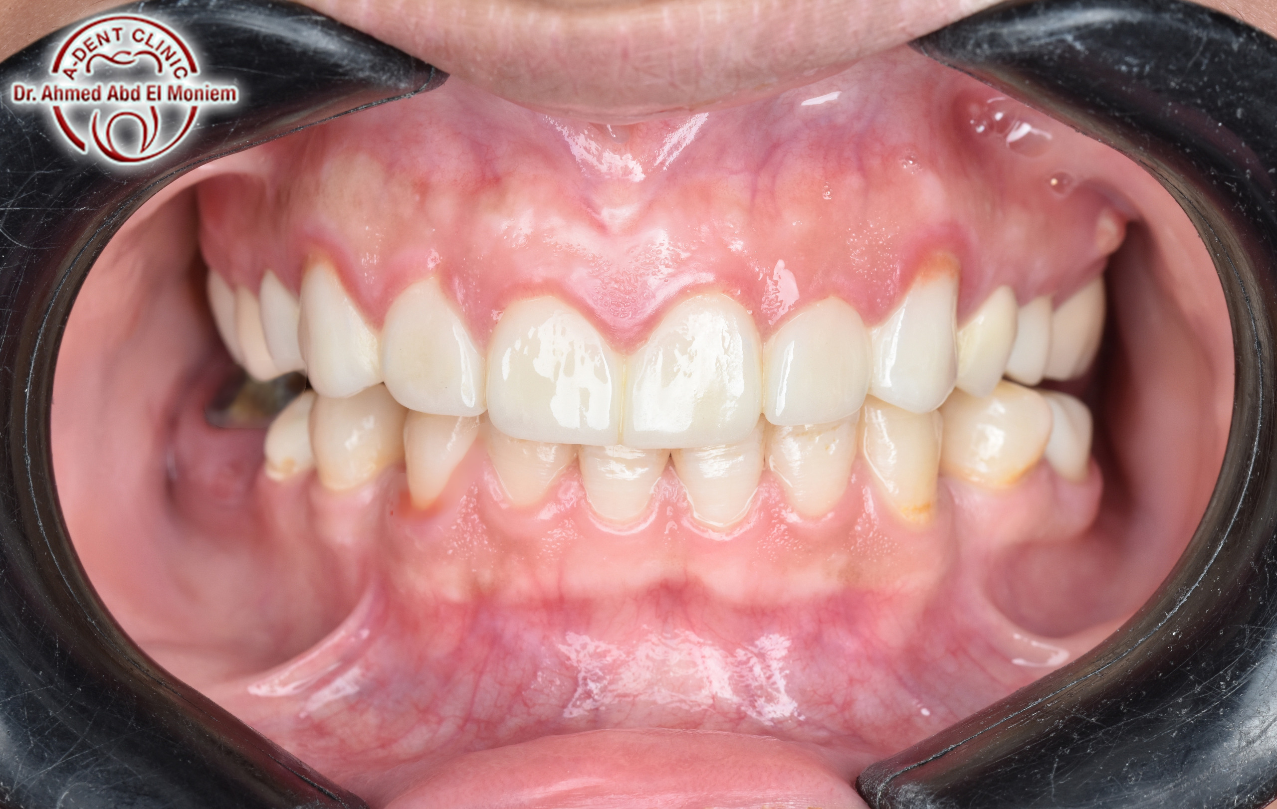 Before: case 18