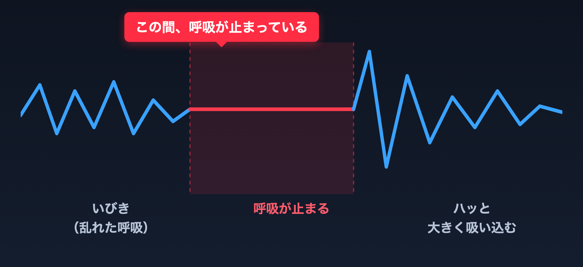 呼吸が止まる波形
