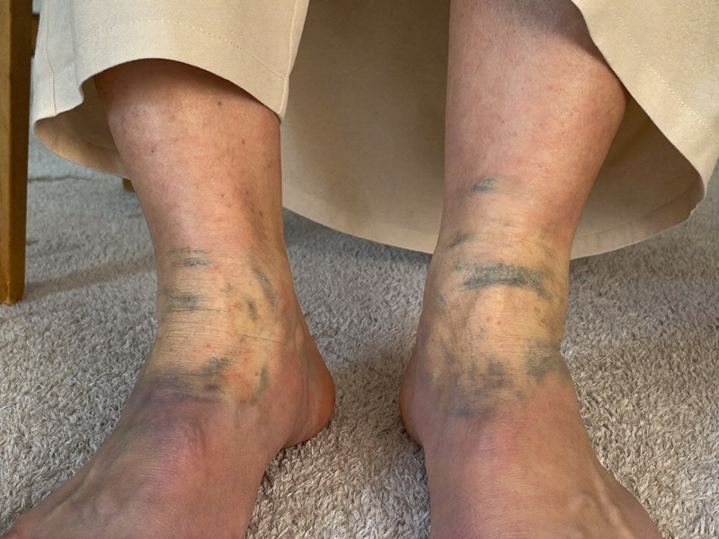 Varicose veins and swollen ankles before the program