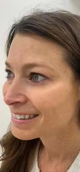 Customer skin looking smoother after the spicule serum
