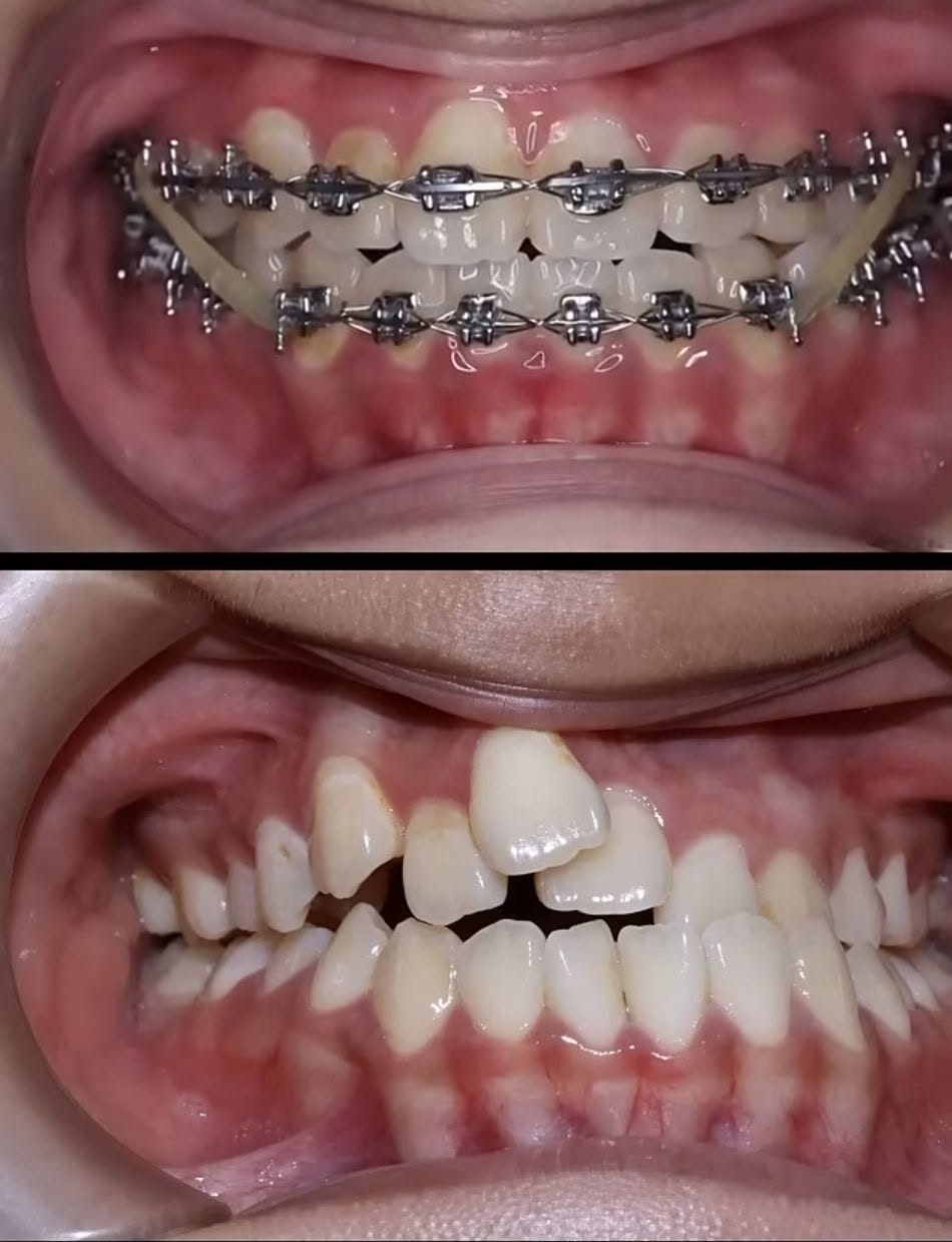 Antes y después - Resina estética, Mundo Dental Kids