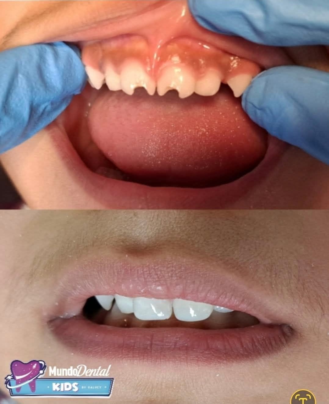Antes y después - Ortodoncia, Mundo Dental Kids