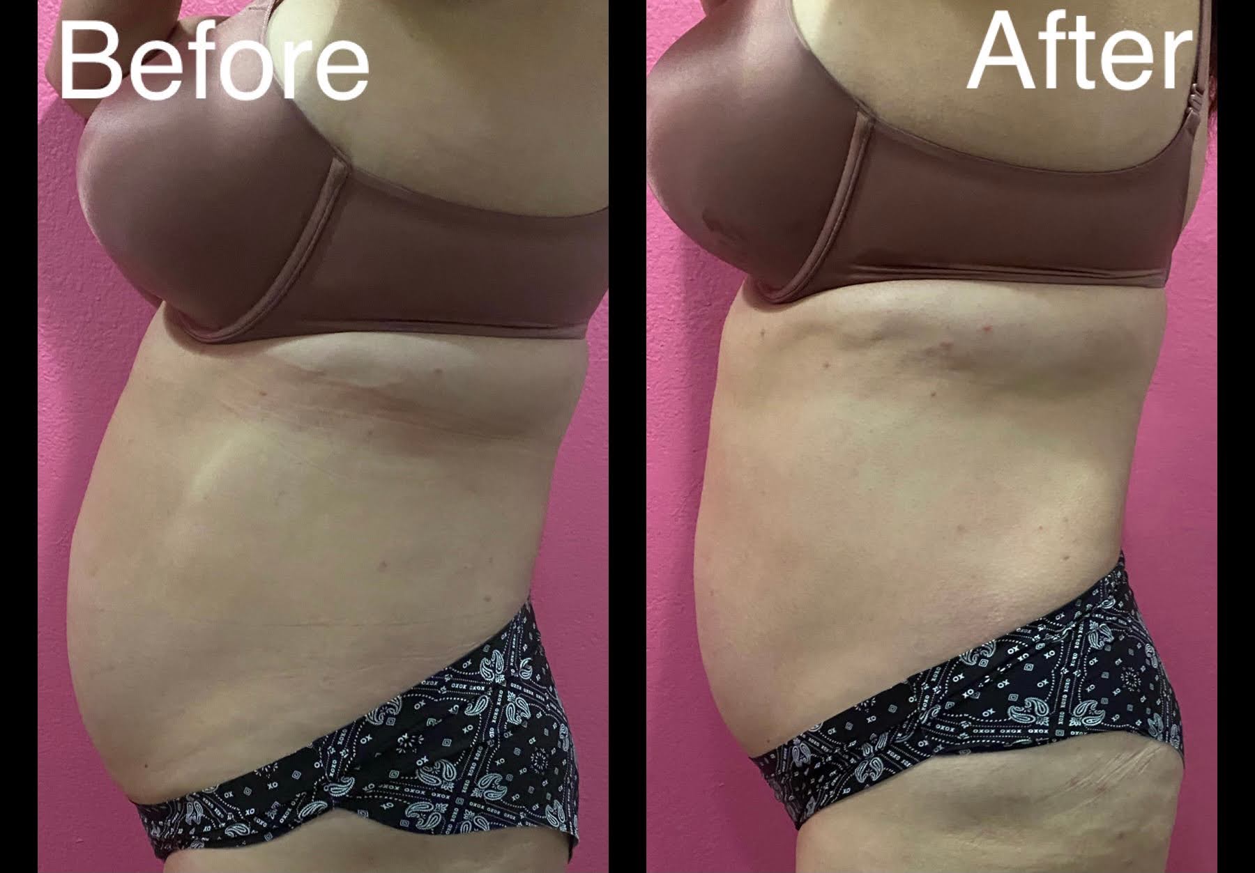 Consented client body-contouring result
