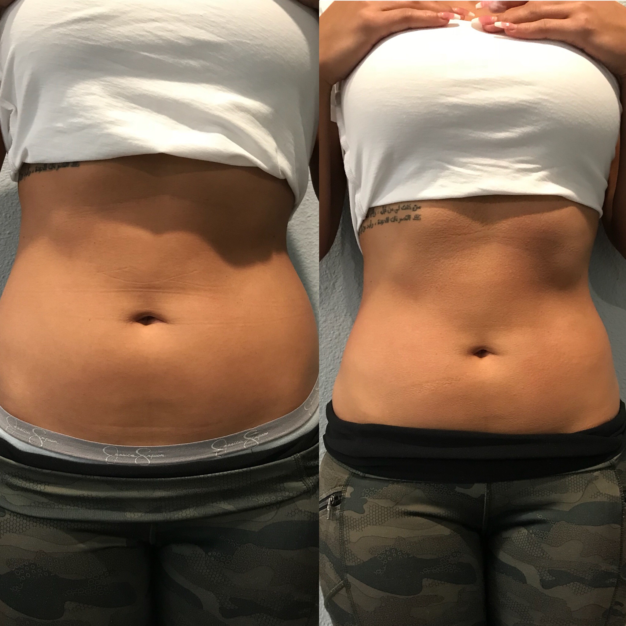 Consented client body-contouring result