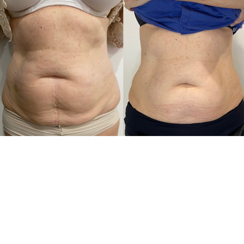 Consented client body-contouring result
