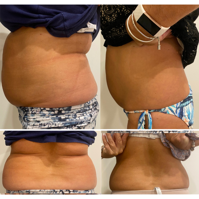 Consented client body-contouring result