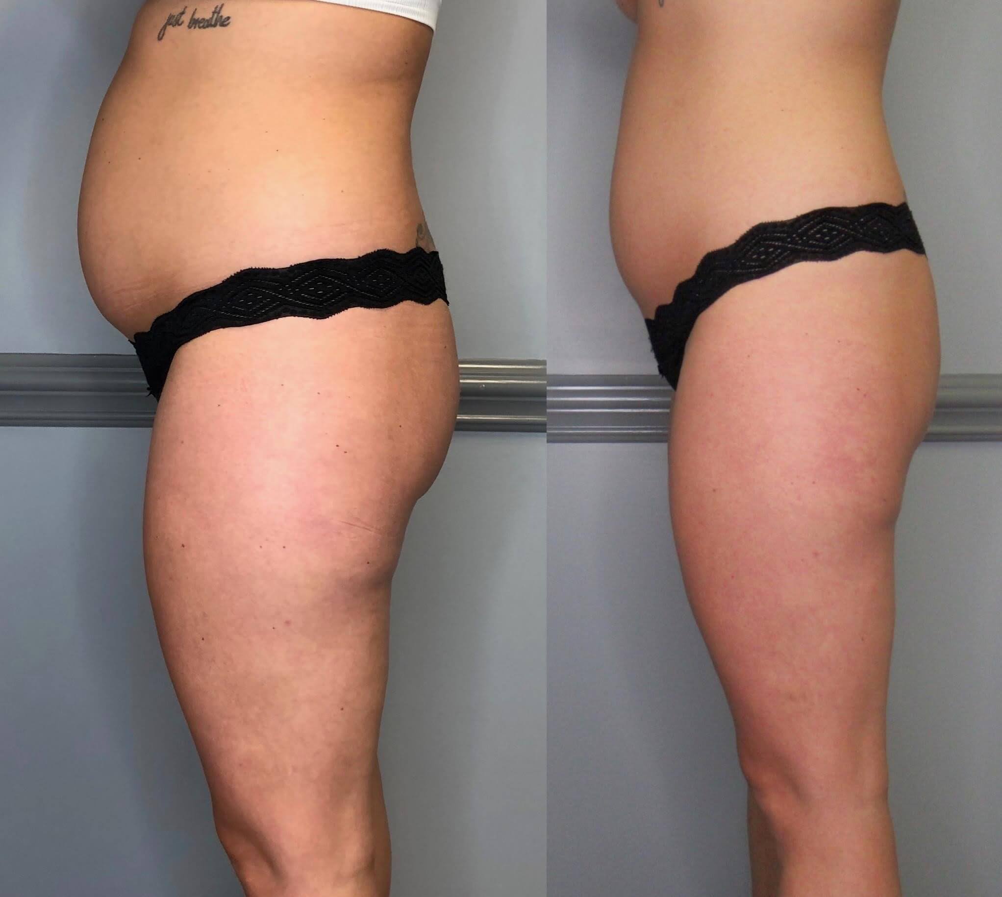 Consented client body-contouring result